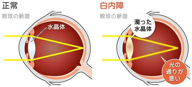 白内障とは？