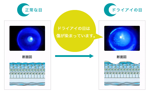 ドライアイの検査方法