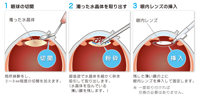 手術