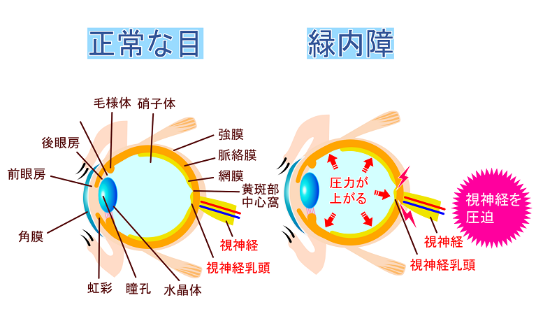 緑内障とは？