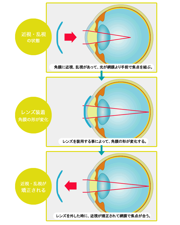 オルソケラトロジーとは？